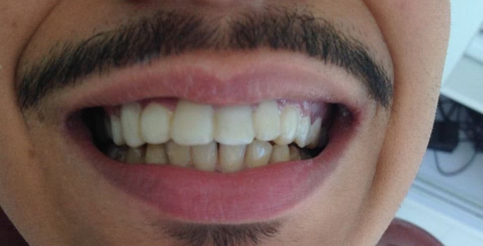 Après facettes dentaires — Dr Benkirane Agadir, cas n°2