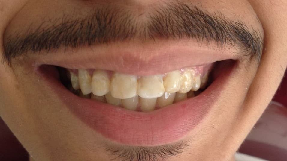 Avant facettes dentaires — Dr Benkirane Agadir, cas n°2