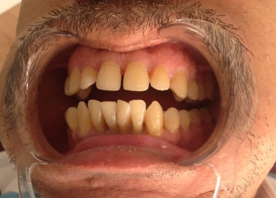 Avant blanchiment et esthétique dentaire — cabinet Benkirane, cas n°3